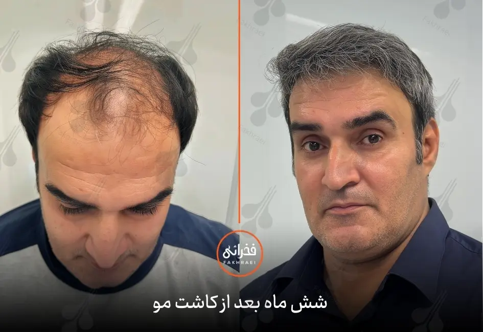نتیجه کاشت مو بعد از شش ماه