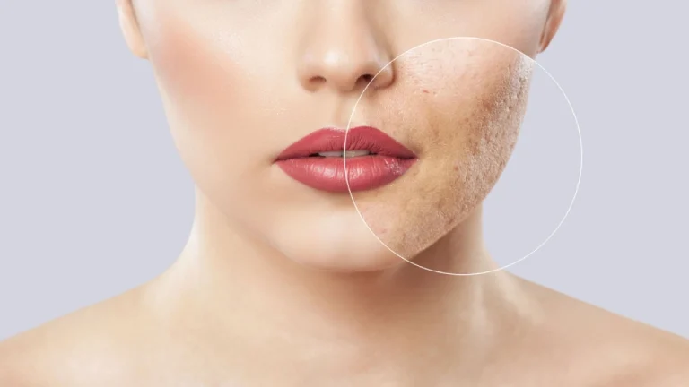 سابسیژن صورت چیست؟ | جدیدترین روش درمان جای جوش و اسکار