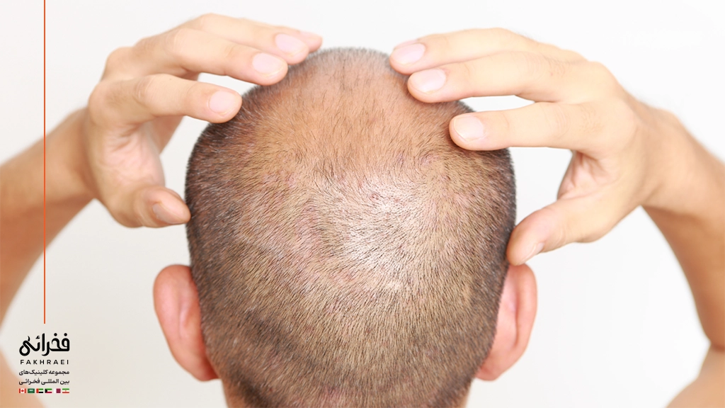 وضعیت بانک مو ۱۴ روز پس از کاشت